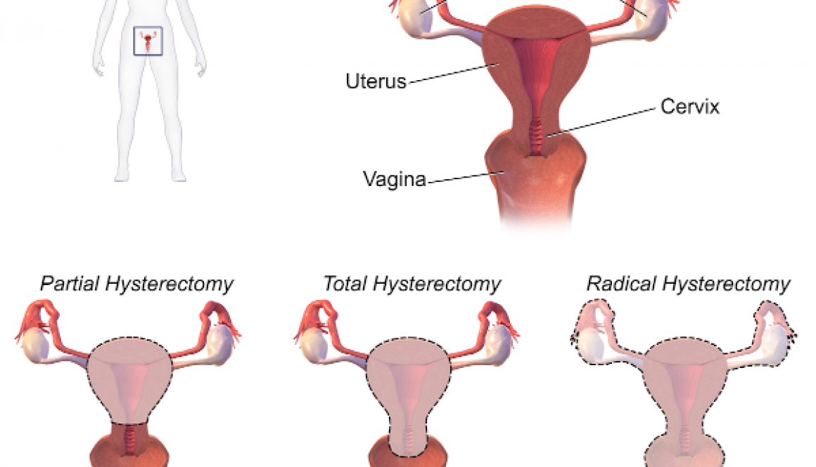 Full Hysterectomy
