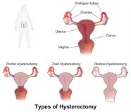 Full Hysterectomy