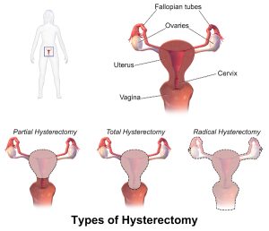 Full Hysterectomy