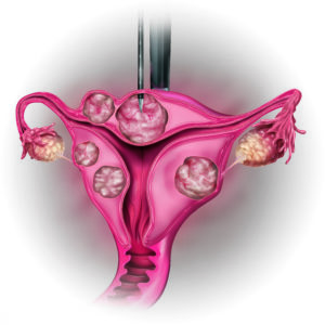 Step 2:<br>Identify Fibroids