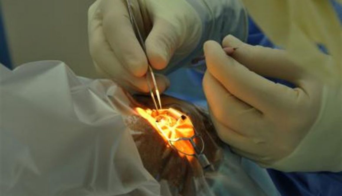 Uterine Fibroids Laser Treatment