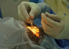 Uterine Fibroids Laser Treatment