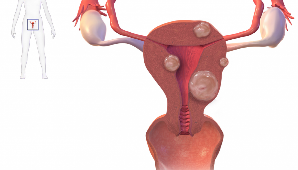 Uterine Fibroids