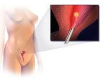 Endometrial Ablation