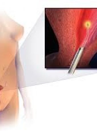 Endometrial Ablation