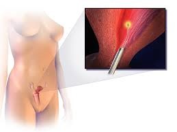 Endometrial Ablation
